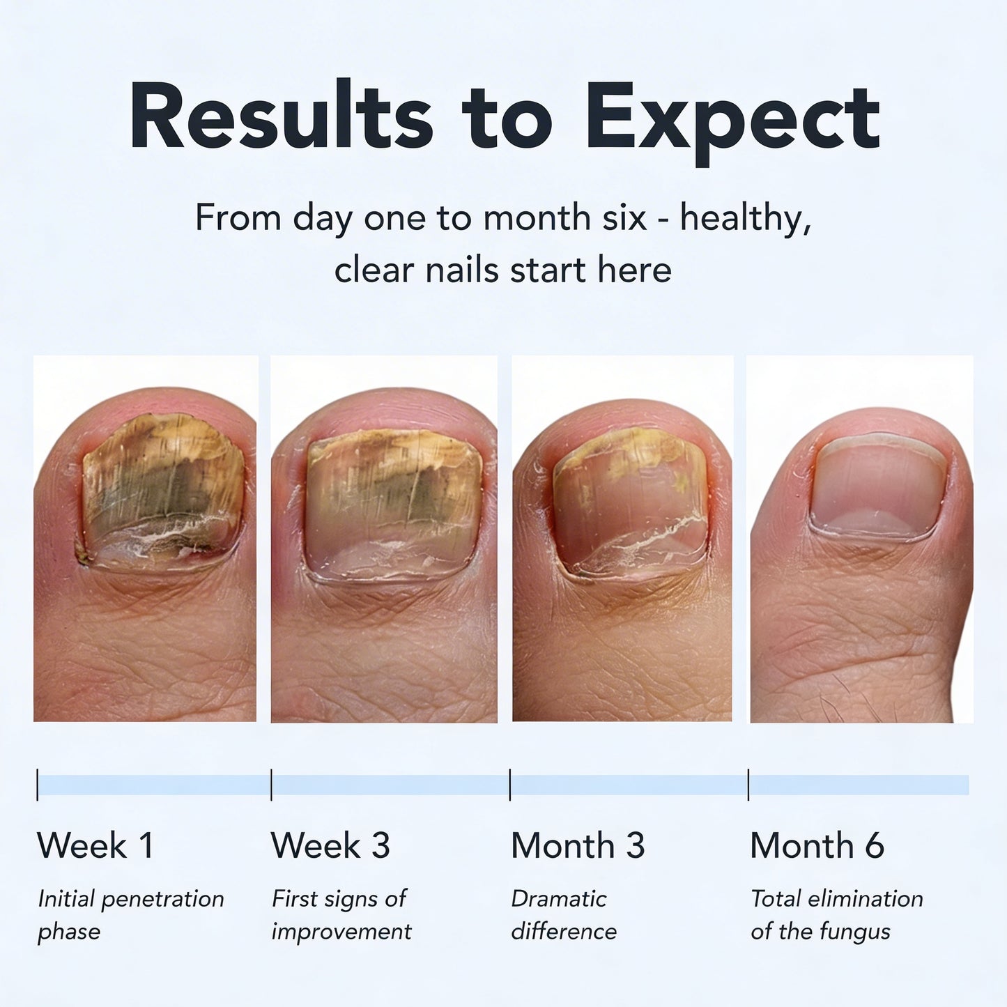 Clavira™ Antifungal Pen